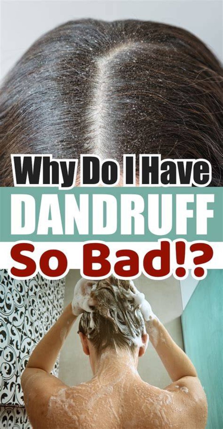 Do all races get dandruff?