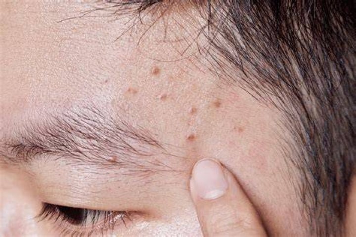 Do bangs cause acne?