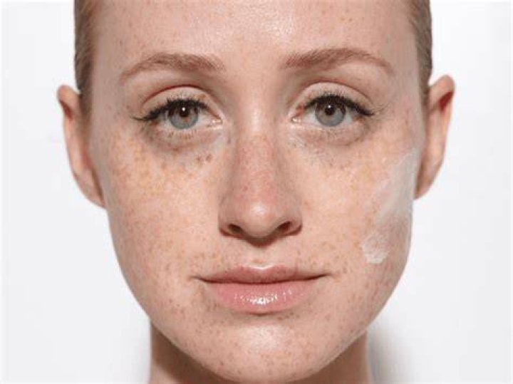 Do gingers have thinner skin?