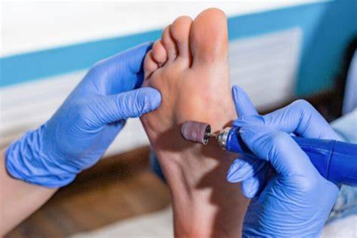 Do gymnasts have calluses?