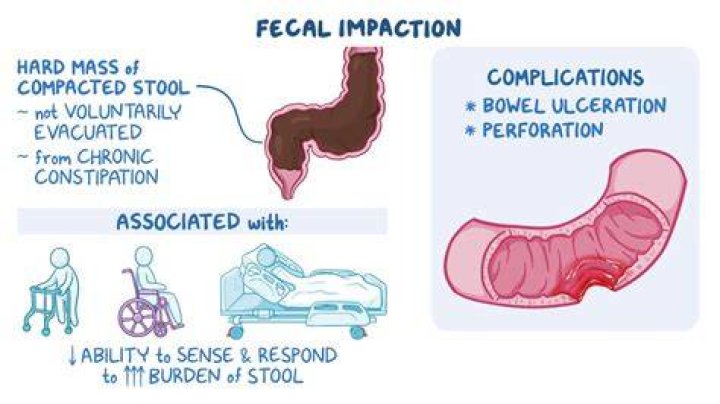 Do I have fecal impaction or just constipation?