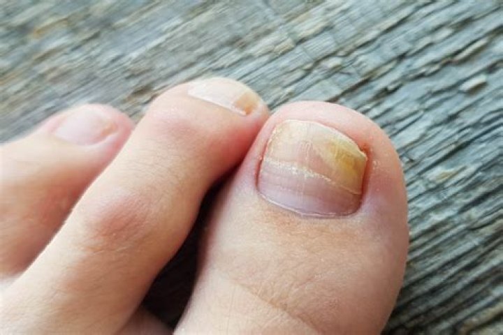 Do long nails cause acne?