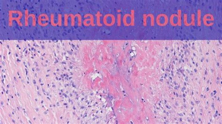 Do rheumatoid nodules burst?