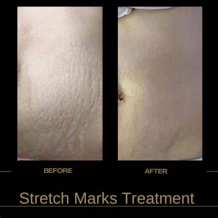 Do squats get rid of stretch marks?