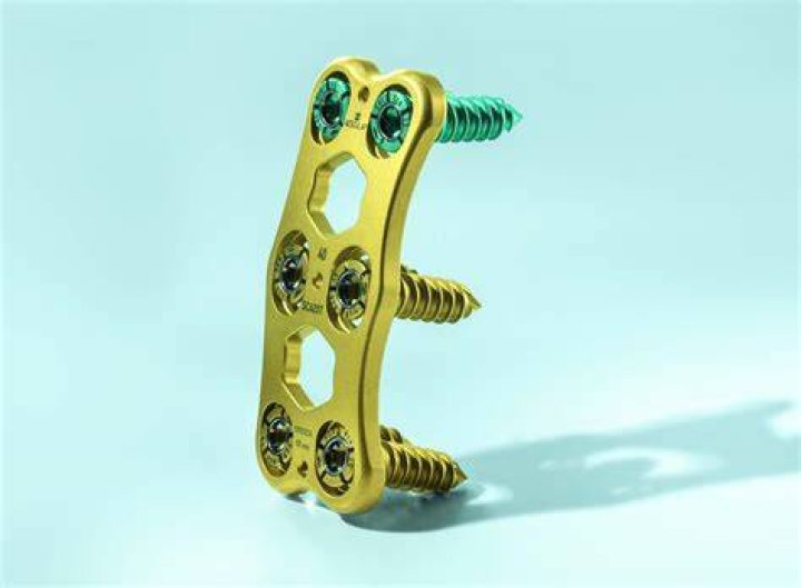 Do titanium screws need to be removed?