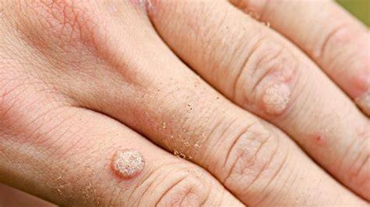 Do warts have pus?