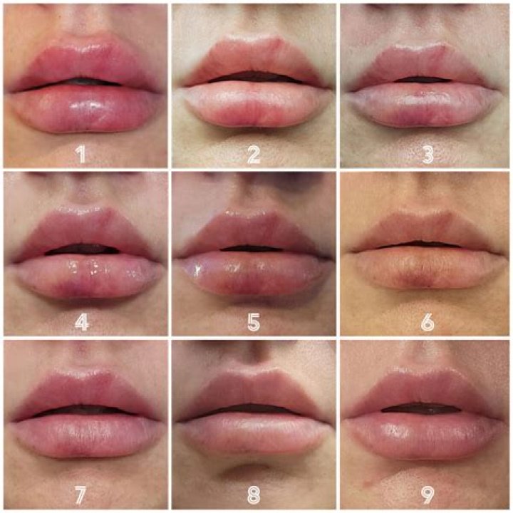 Do you bruise from a lip flip?