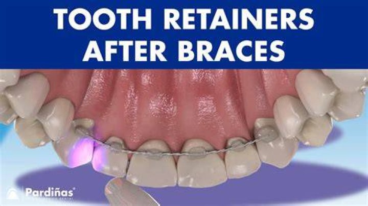 Do you need retainers forever after braces?