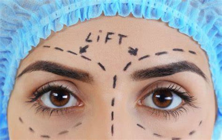Does a facelift include eyelids?