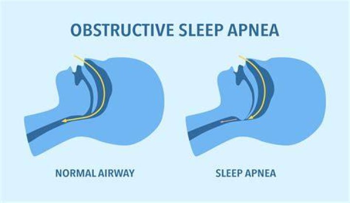 Does air quality affect snoring?