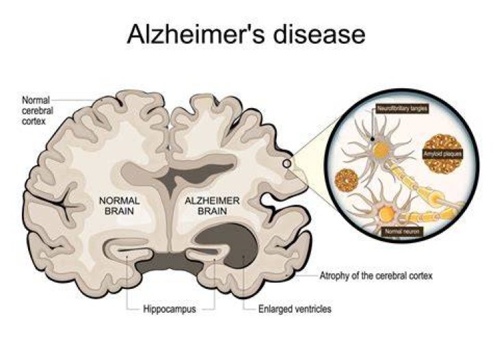 Does ALS cause dementia?