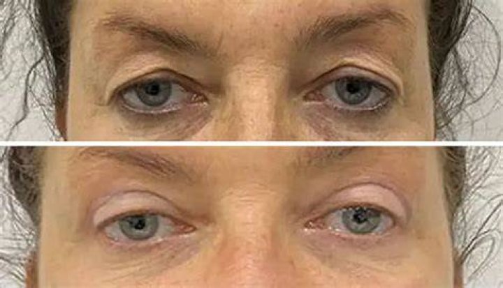 Does blepharoplasty make you look younger?