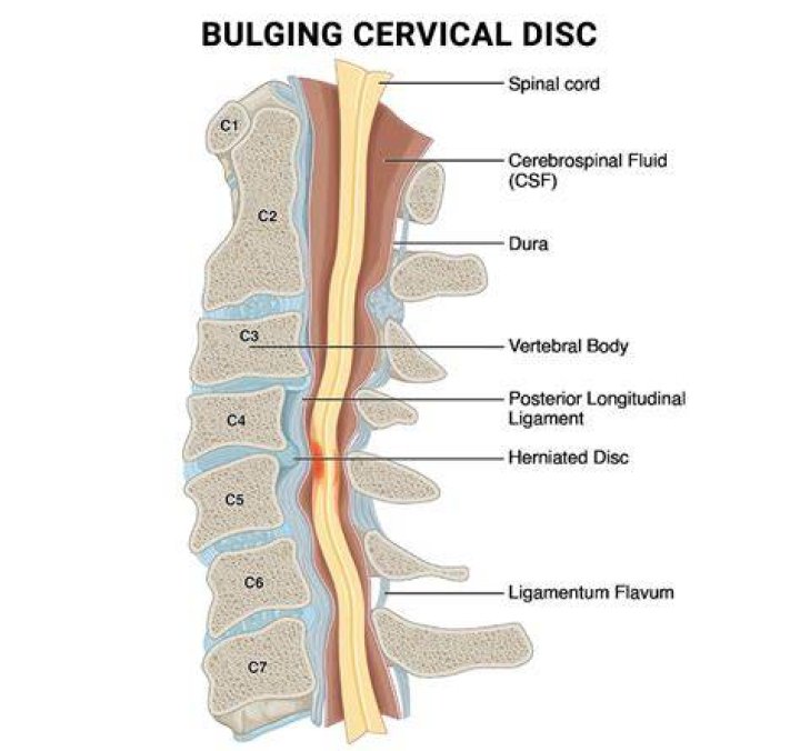 Does C-section bulge go away?