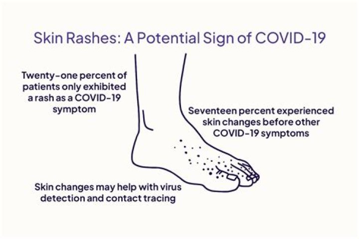 Does Covid 19 cause uvulitis?