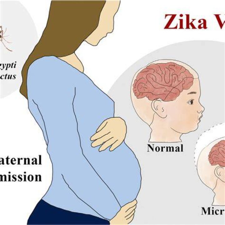 Does every pregnant woman with Zika have microcephaly?