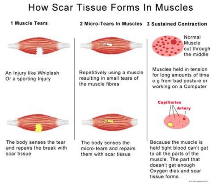 Does heat help break up scar tissue?