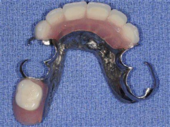 Does it hurt to get a partial denture?
