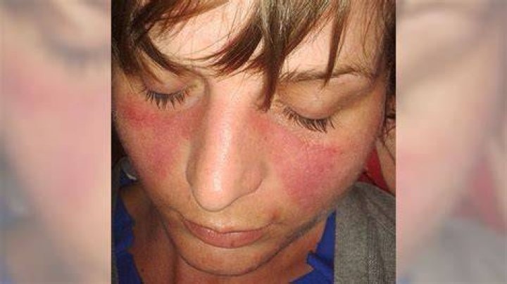 Does lupus make you sweat a lot?