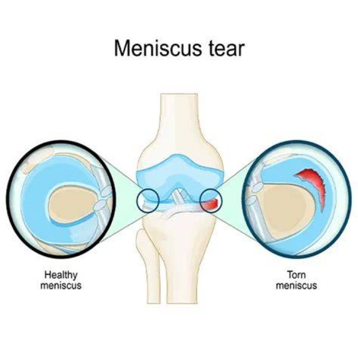 Does meniscus tear hurt to touch?