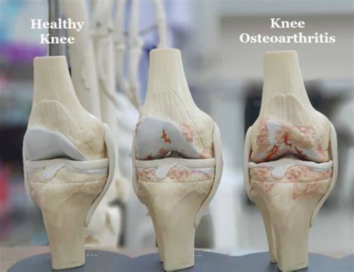Does osteoarthritis hurt all the time?