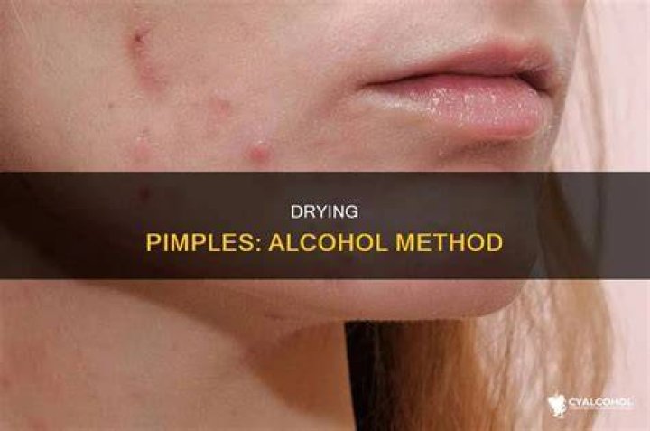 Does rubbing alcohol dry out pimples?