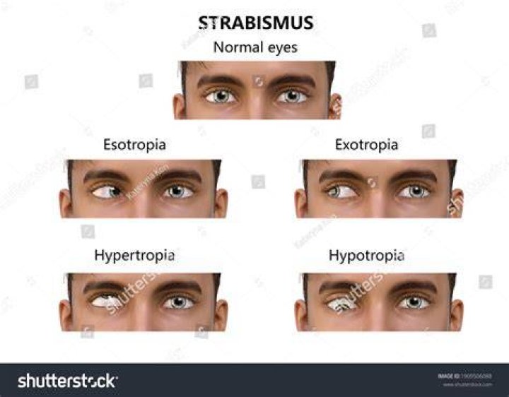Does strabismus cause head tilt?