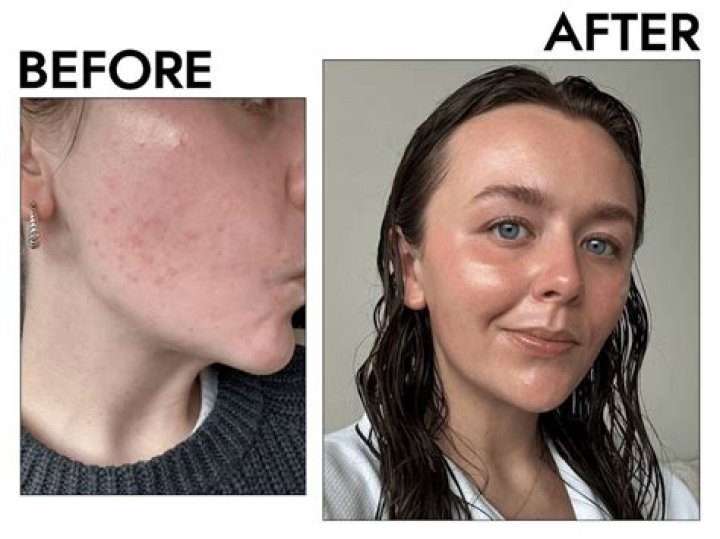 Does tretinoin cause facial hair growth?
