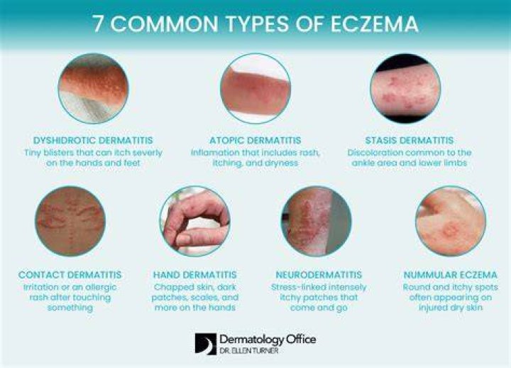 Does vitamin C make eczema worse?