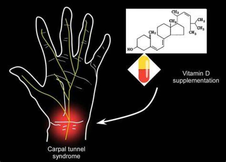 Does Vitamin D Help carpal tunnel?