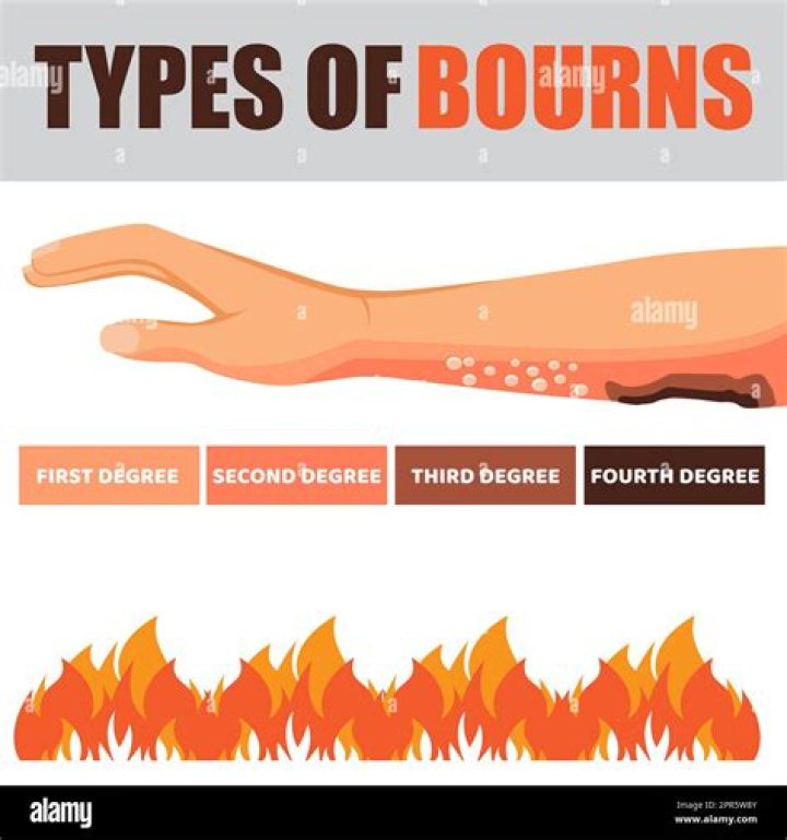 Does walking on fire burn your feet?