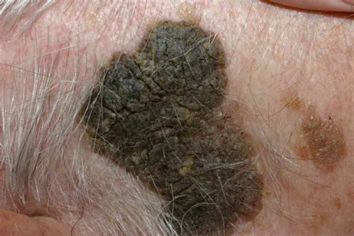 How big can seborrheic keratosis get?