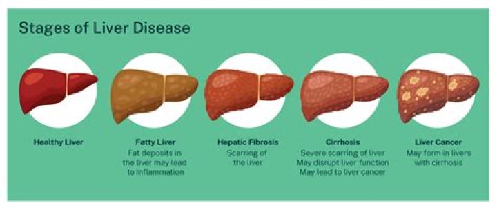 How can I stop my cirrhosis from getting worse?