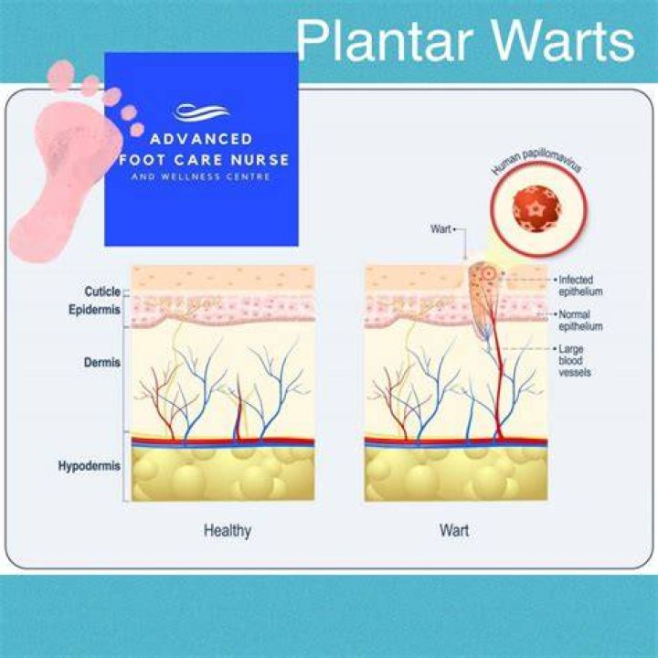 How deep is a plantar wart?