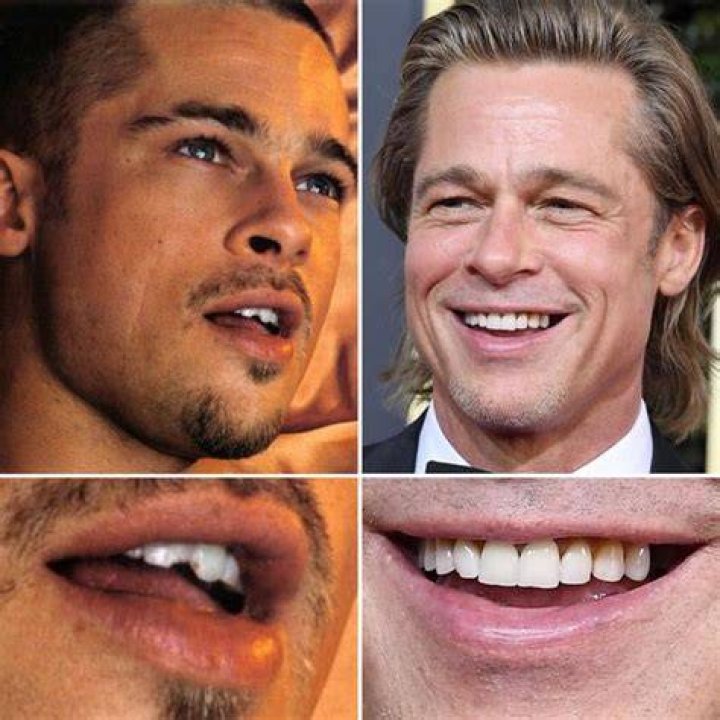 How do Hollywood stars have perfect teeth?