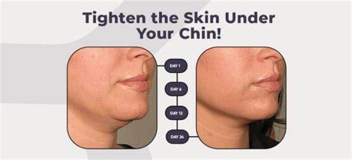 How do I get rid of the extra skin under my chin?