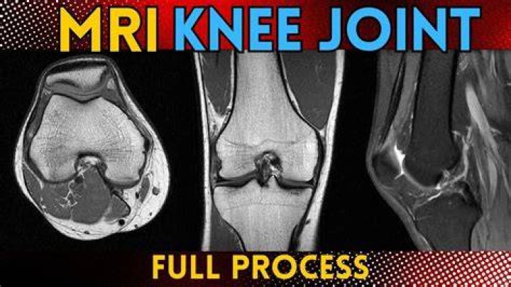 How do I know if I need an MRI on my knee?