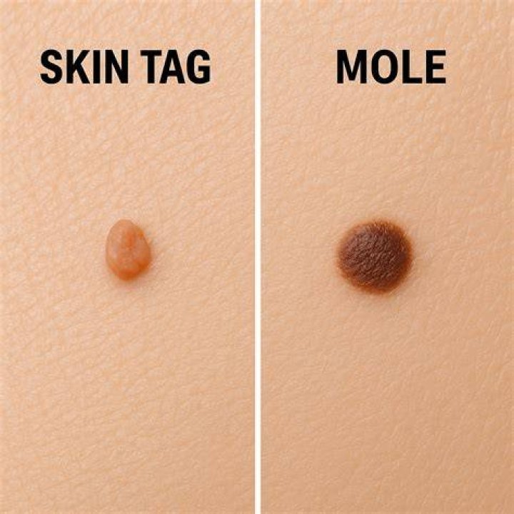 How do I know if its a mole or skin tag?