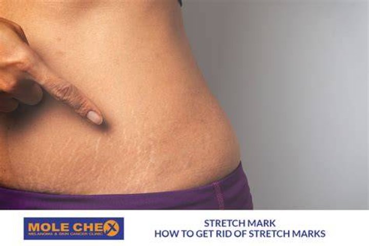 How do models get rid of stretch marks?