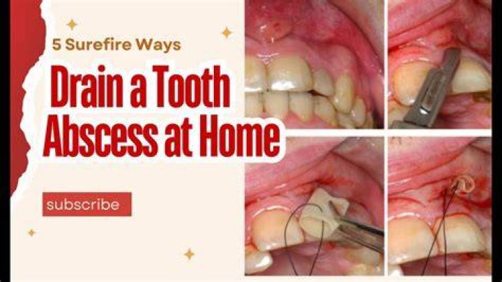 How do you drain a tooth abscess at home?