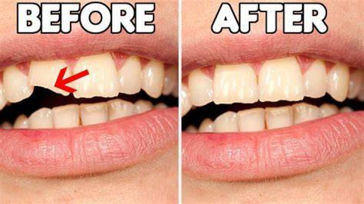 How do you fix a rotten tooth?