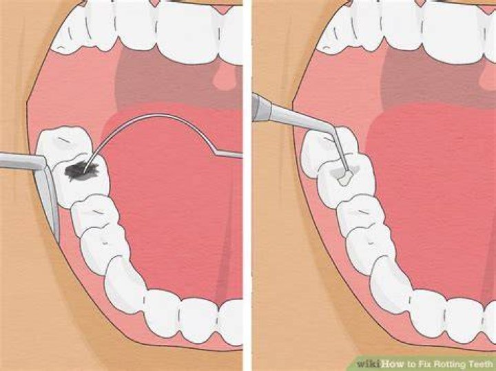 How do you fix rotting teeth?
