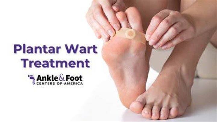 How do you get rid of HPV warts on your feet?
