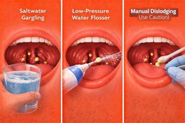 How do you get rid of tonsil stones without touching them?