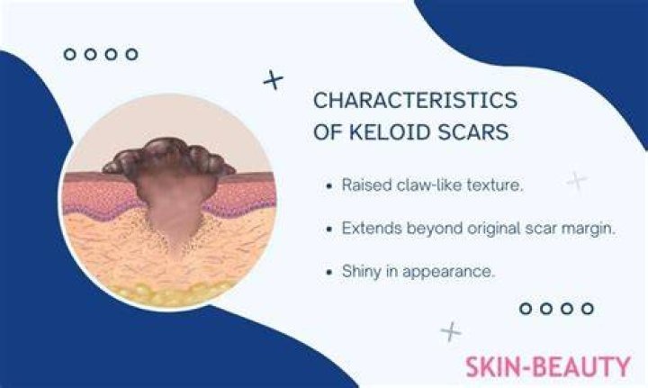 How do you know if you are Keloidal?