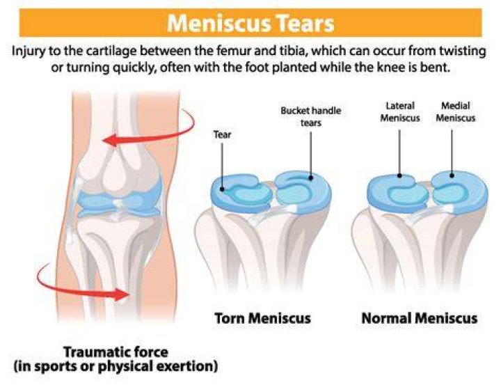 How do you know if you have a torn meniscus in your knee?