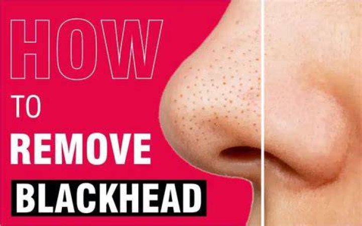 How do you remove a deep blackhead?