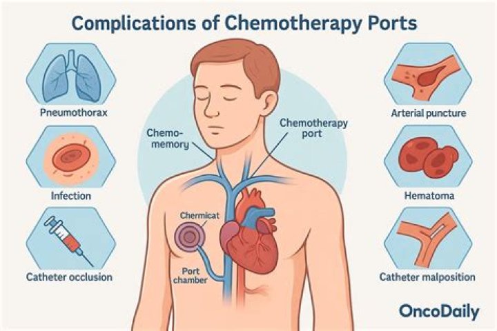How do you shower with a chemo port?