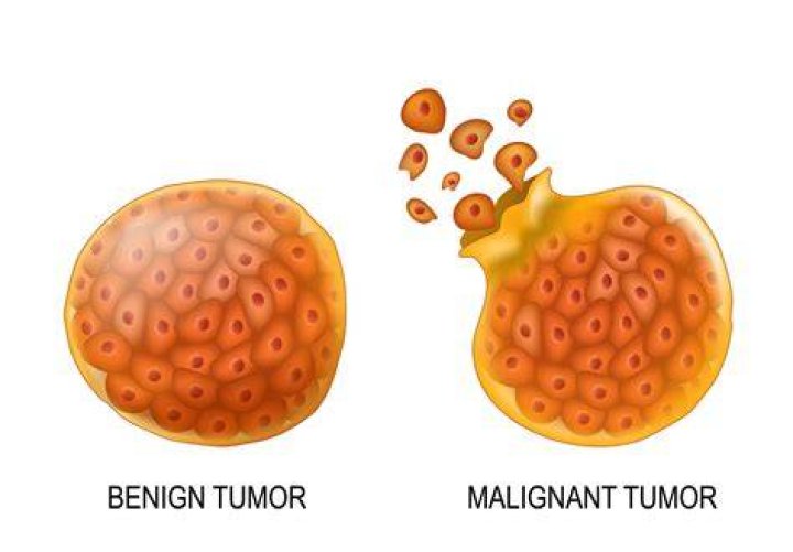 How do you shrink a benign tumor?