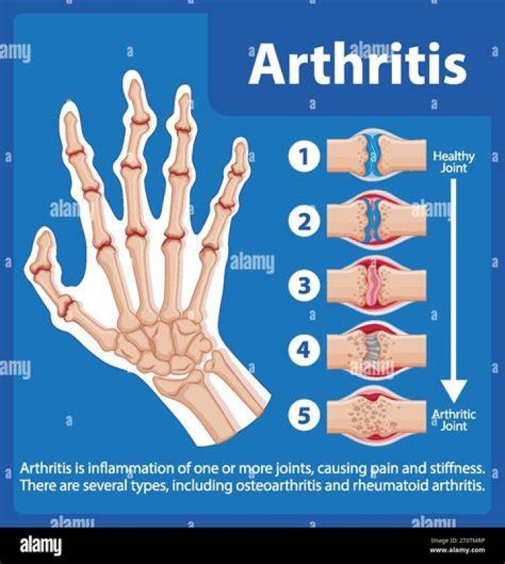 How do you stop arthritis fingers from progressing?