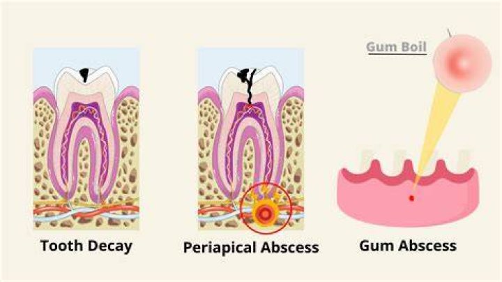 How do you tell if an abscess is healing?